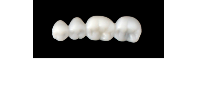 Cod.S2LOWER RIGHT : 15x  posterior solid (not hollow) wax bridges, MEDIUM, (44-47) , with precarved occlusion to Cod.S2UPPER RIGHT,and compatible to Cod.E2LOWER RIGHT (hollow), (44-47)